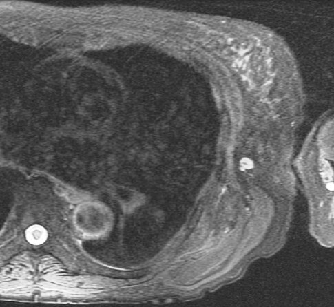 Figure 2 for case Elastofibroma dorsi
